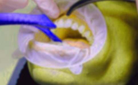 拔牙作文300字(通用32篇)